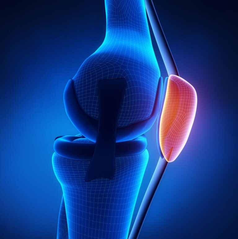 Medial Patellafemoral Ligament Reconstruction Los Angeles CA Dr