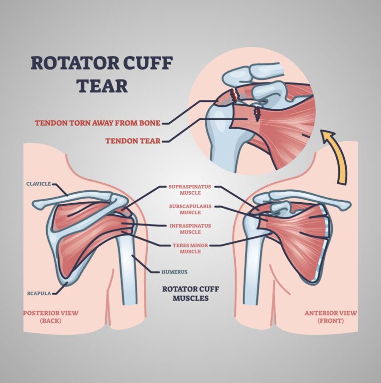 Rotator Cuff Arthropathy Los Angeles Ca Dr Jason Snibbe