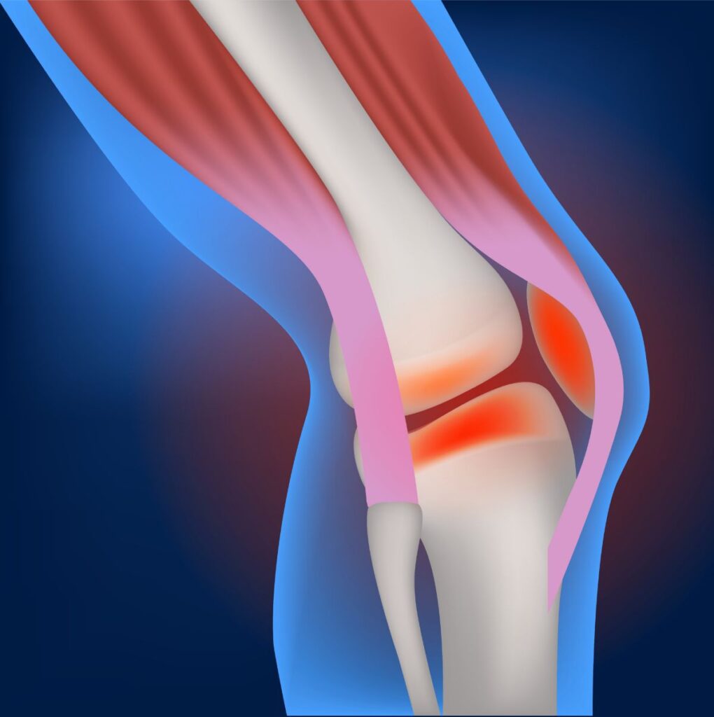 MCL Injury, Medial Collateral Ligament