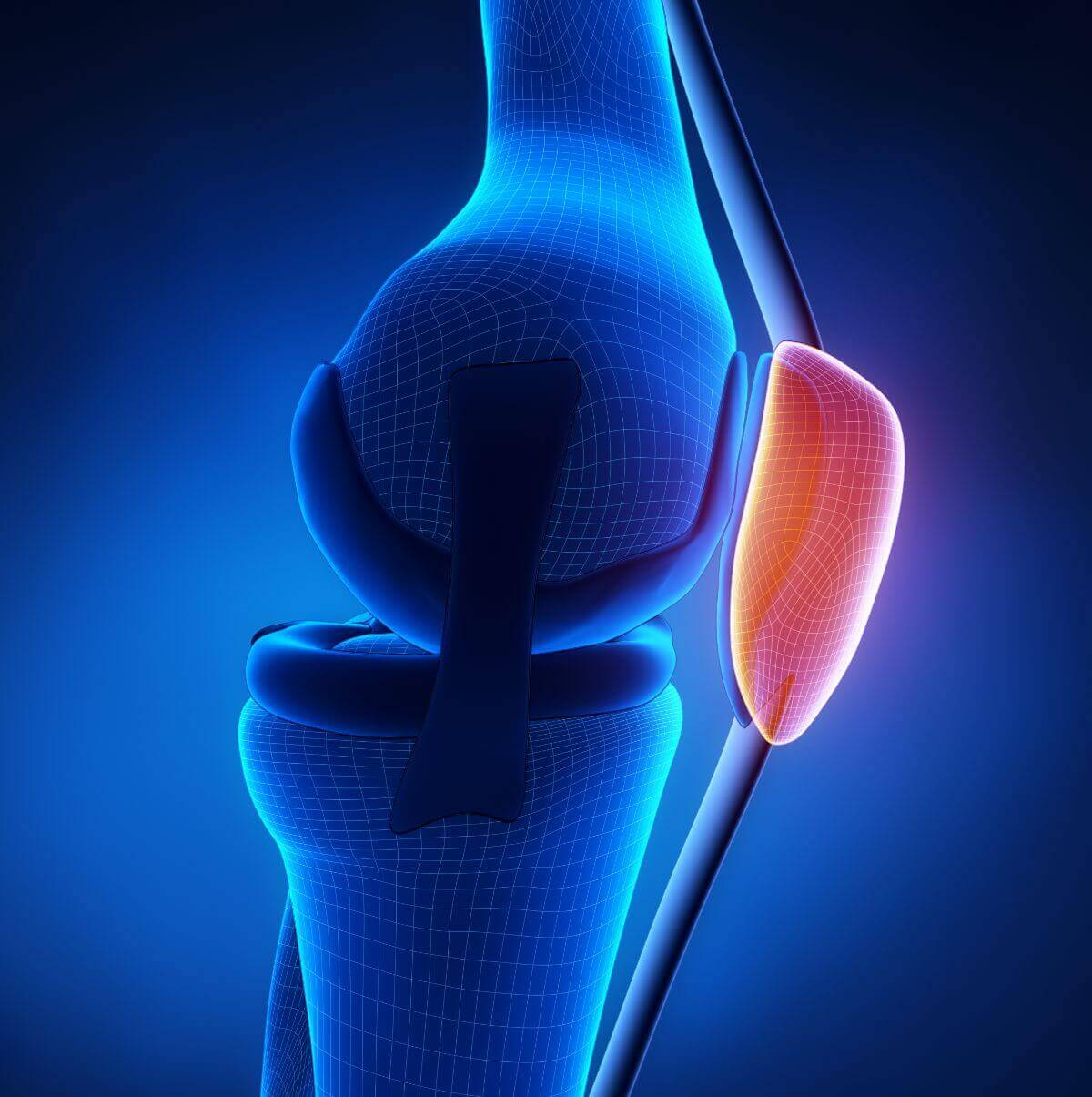 Medial Patellafemoral Ligament Reconstruction - Los Angeles, CA - Dr ...