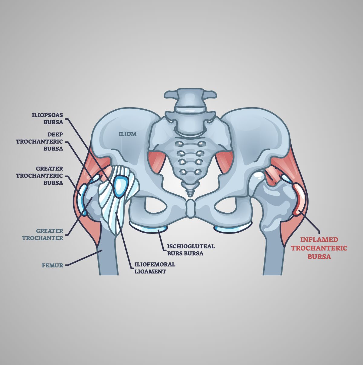 Trochanteric Bursitis - Los Angeles, CA - Dr. Jason Snibbe